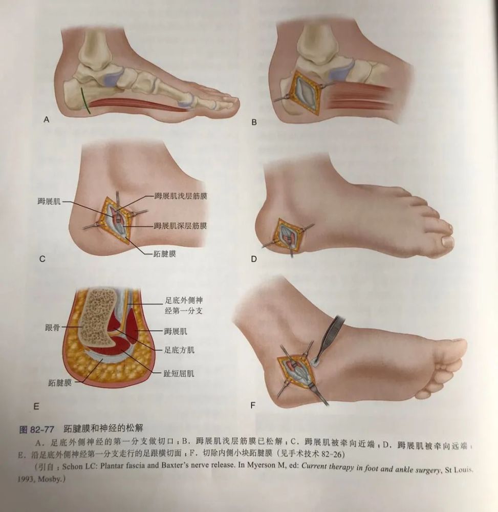 足跟痛,筋膜,跟骨,足底,足底筋膜炎,跖筋膜炎