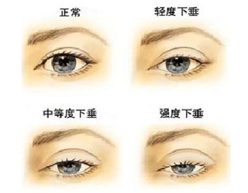 死鱼眼 只做双眼皮手术就能改善吗 看点快报