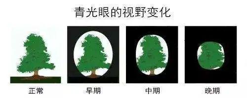 电脑族易发青光眼 出现这些症状需警惕