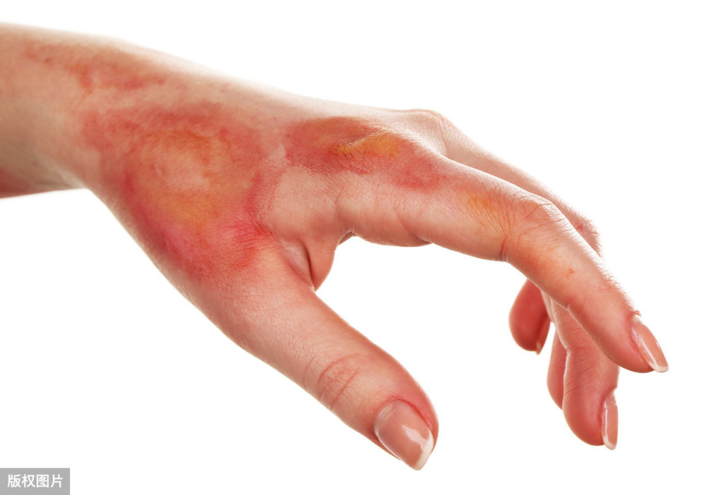 烫伤后可以用碘伏消毒,可有效杀灭破溃皮肤表面的细菌,以防发生感染等