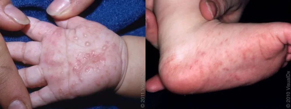 看到手脚上这些皮疹以为是手足口病?这5种都不是哦!