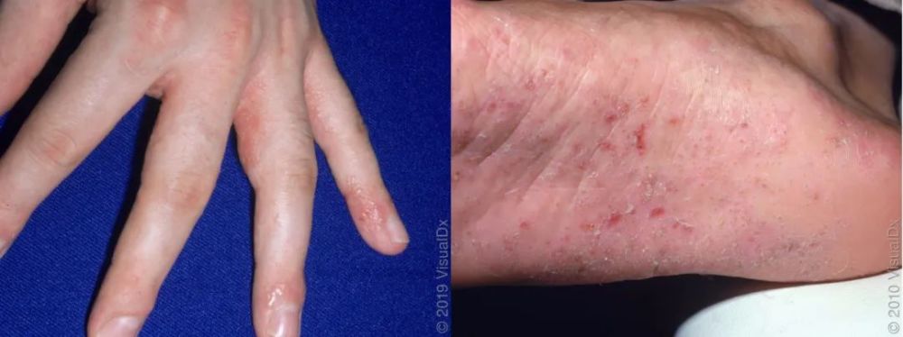 看到手脚上这些皮疹以为是手足口病?这5种都不是哦!