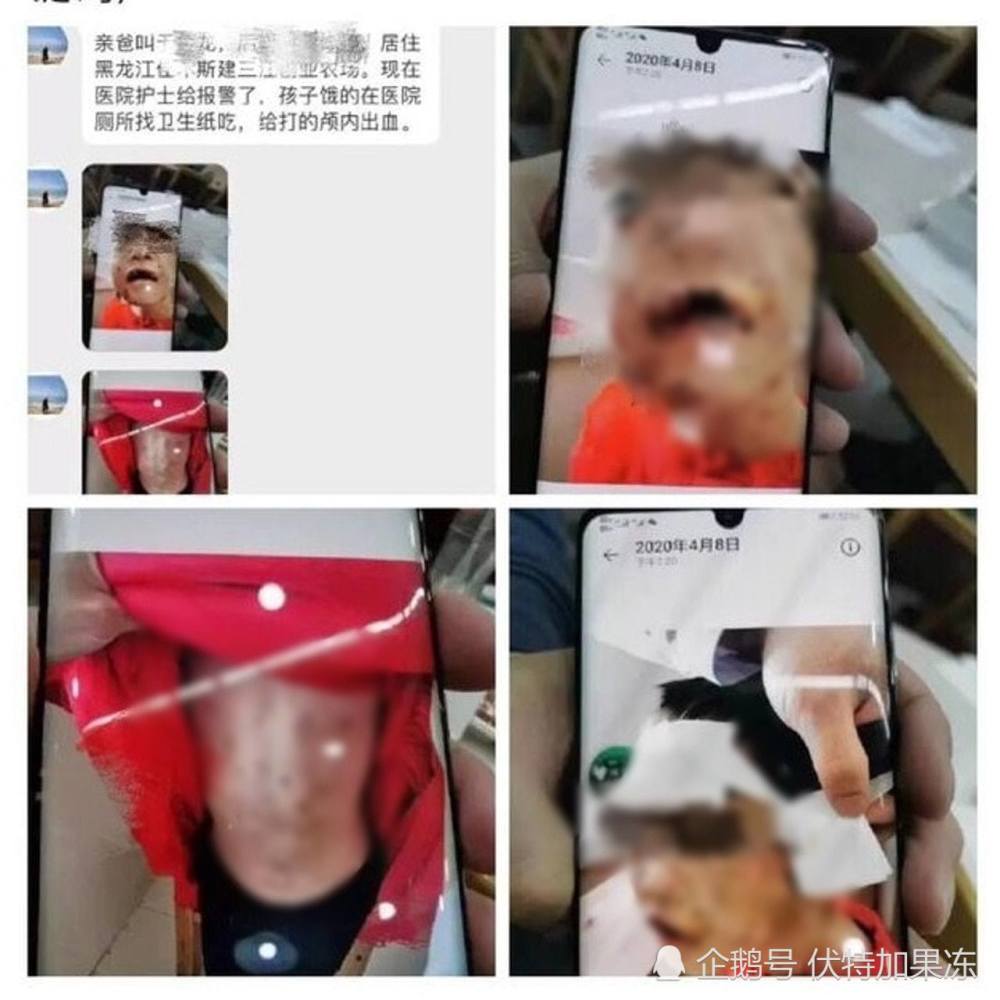 黑龙江4岁女童遭家人虐打嘴唇被剪,父亲及继母被拘!
