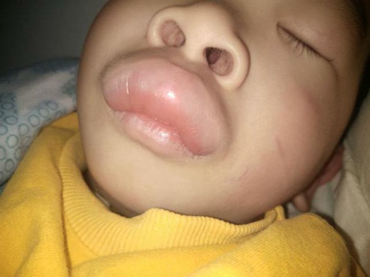 男孩被蚊子咬成香肠嘴,宝妈心疼却忍俊不禁:差点认不出这是我娃