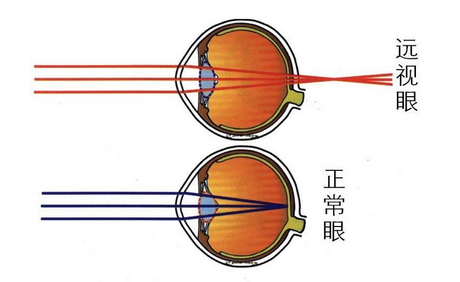 当远视度数较低时,患者可以利用其调节能力,增加眼的屈光力,将光线
