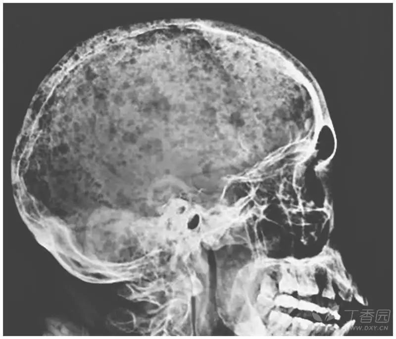 颅骨表面似被"雨滴击穿",呼吸困难并腰痛,3 个月后死亡