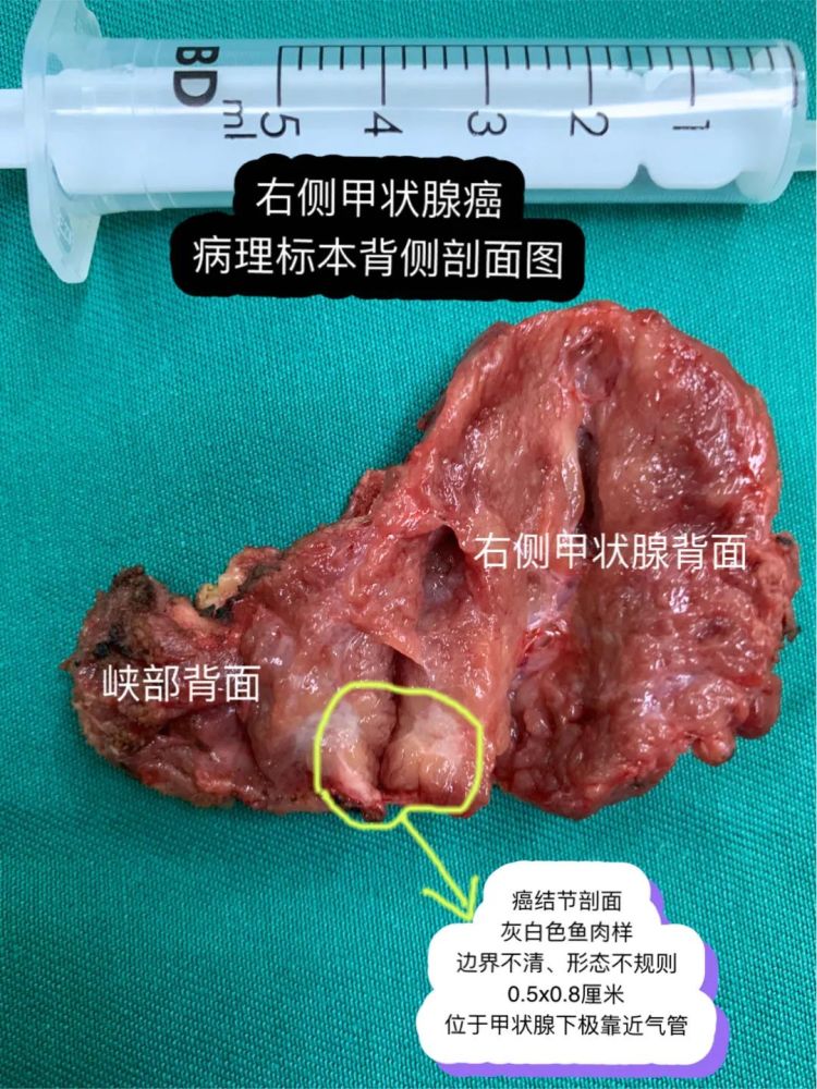 桥本氏甲状腺炎伴甲亢8年反复复发,最后一侧腺体结节变成甲状腺癌