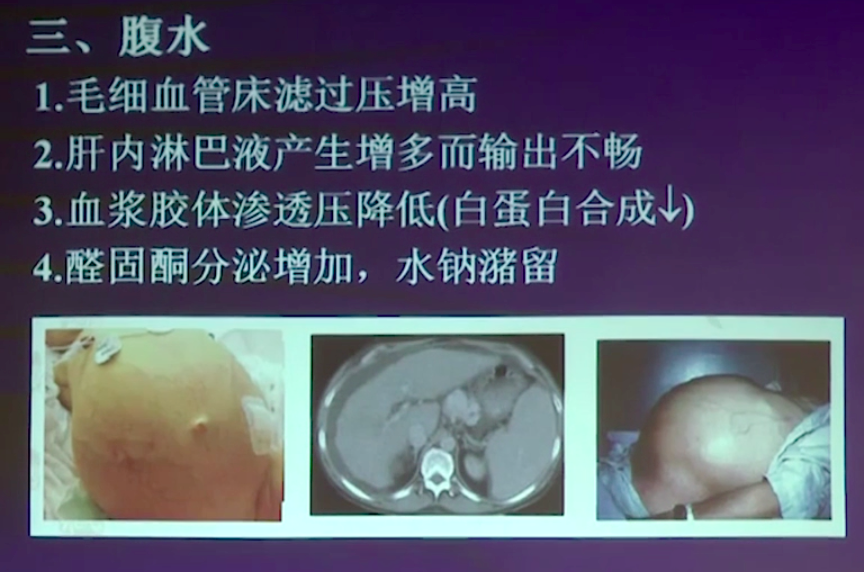 看到腹水就诊断肝硬化,张文宏口中"智商很低"的做法你