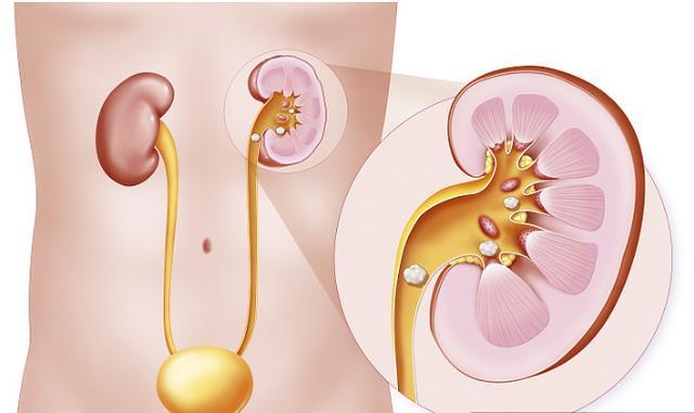 肾结石的"祸根"找到了,贪吃5种食物,让你"痛不欲生"