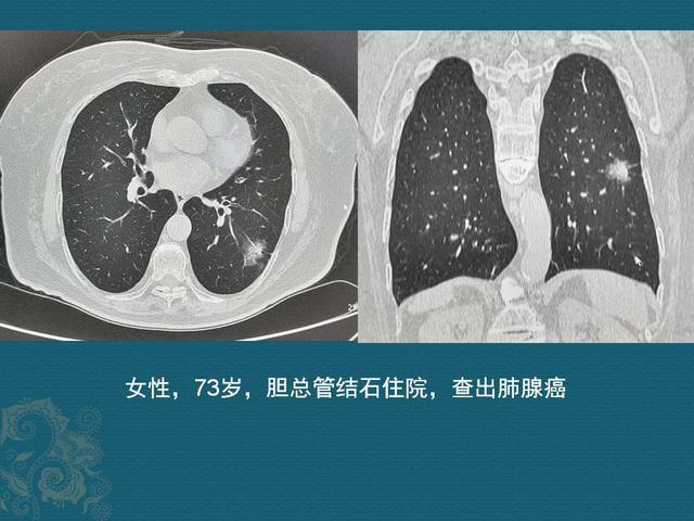 肺癌,磨玻璃结节,肺结节,肺腺癌
