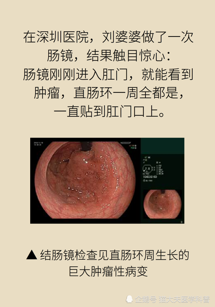 胃肠镜,便血,大肠癌,侧向发育型肿瘤