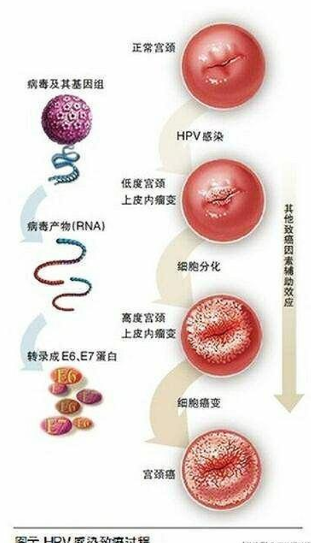 宫颈癌,hpv,宫颈,鳞状上皮细胞