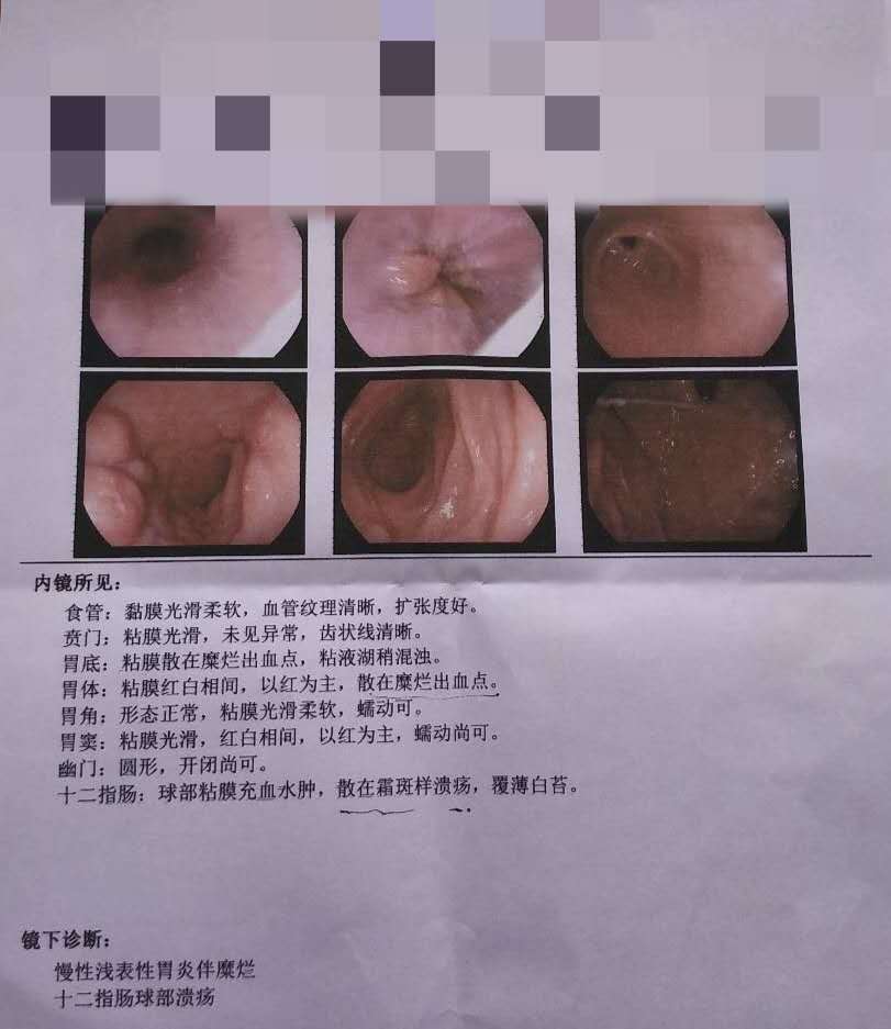 胃疼,胃镜,胃癌