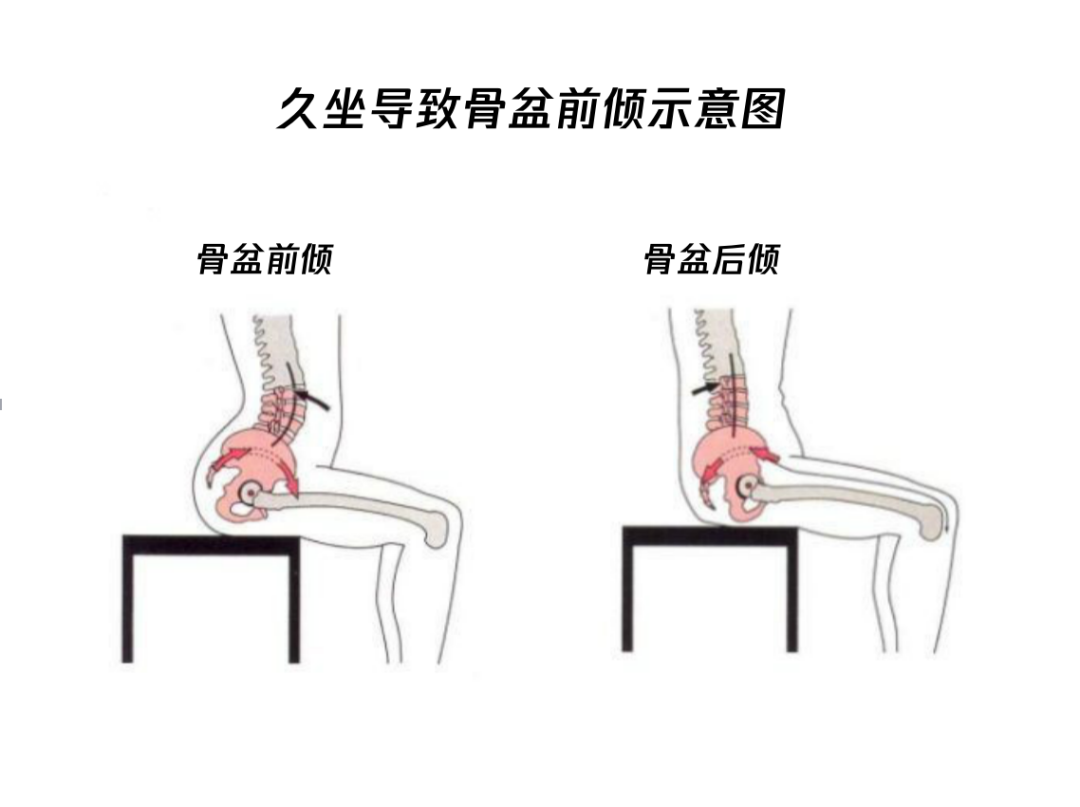 骨盆前倾,骨盆,肌肉,臀部