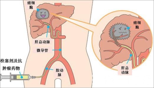 微创介入治疗患者术后即可落地站立