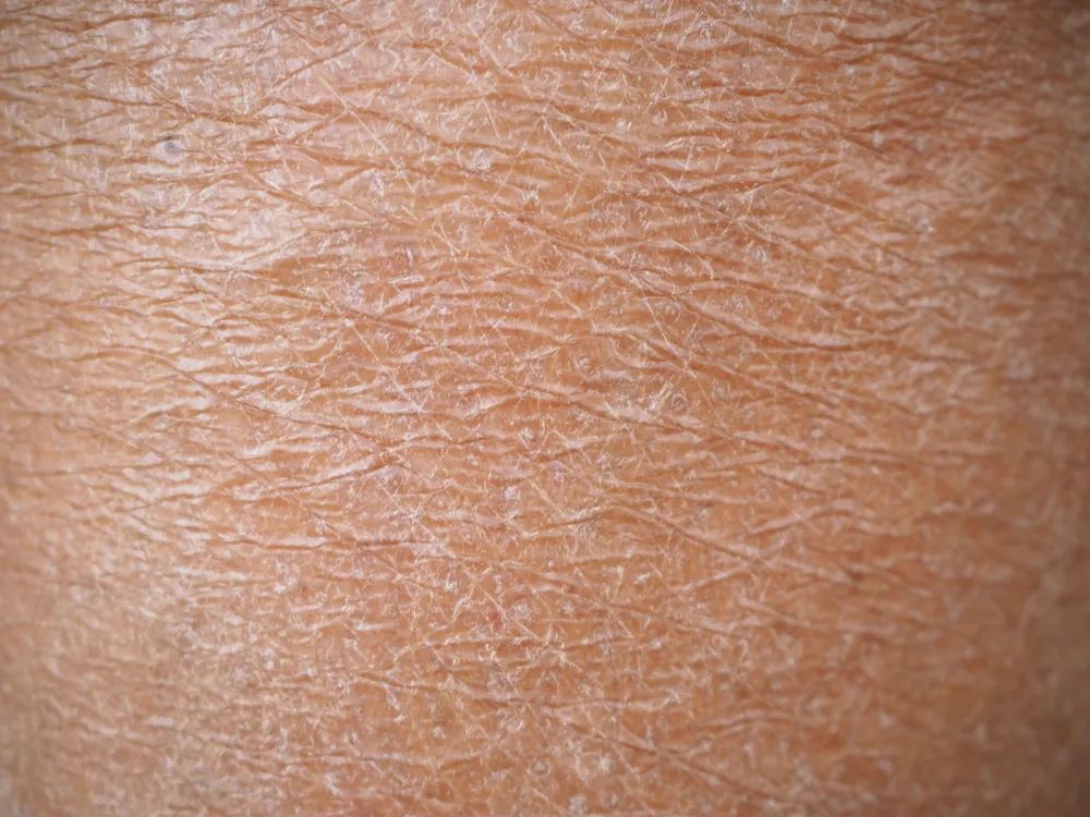 导致皮肤里的保湿因子缺失,让皮肤变干燥