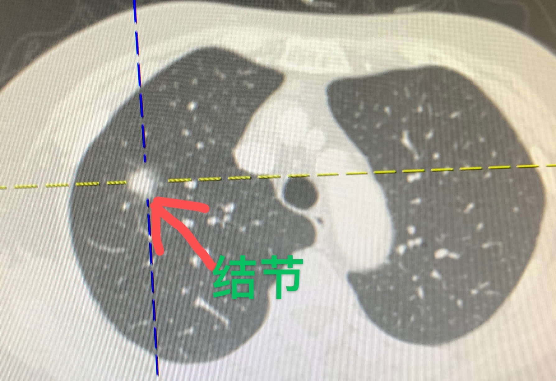 74岁的阿婆发现右上肺结节还需要观察吗?