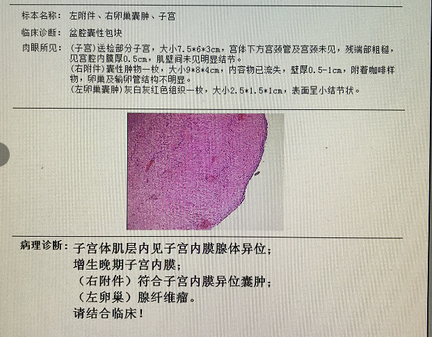 子宫内膜异位症,生殖道畸形,子宫,卵巢囊肿,盆腔,子宫肌瘤