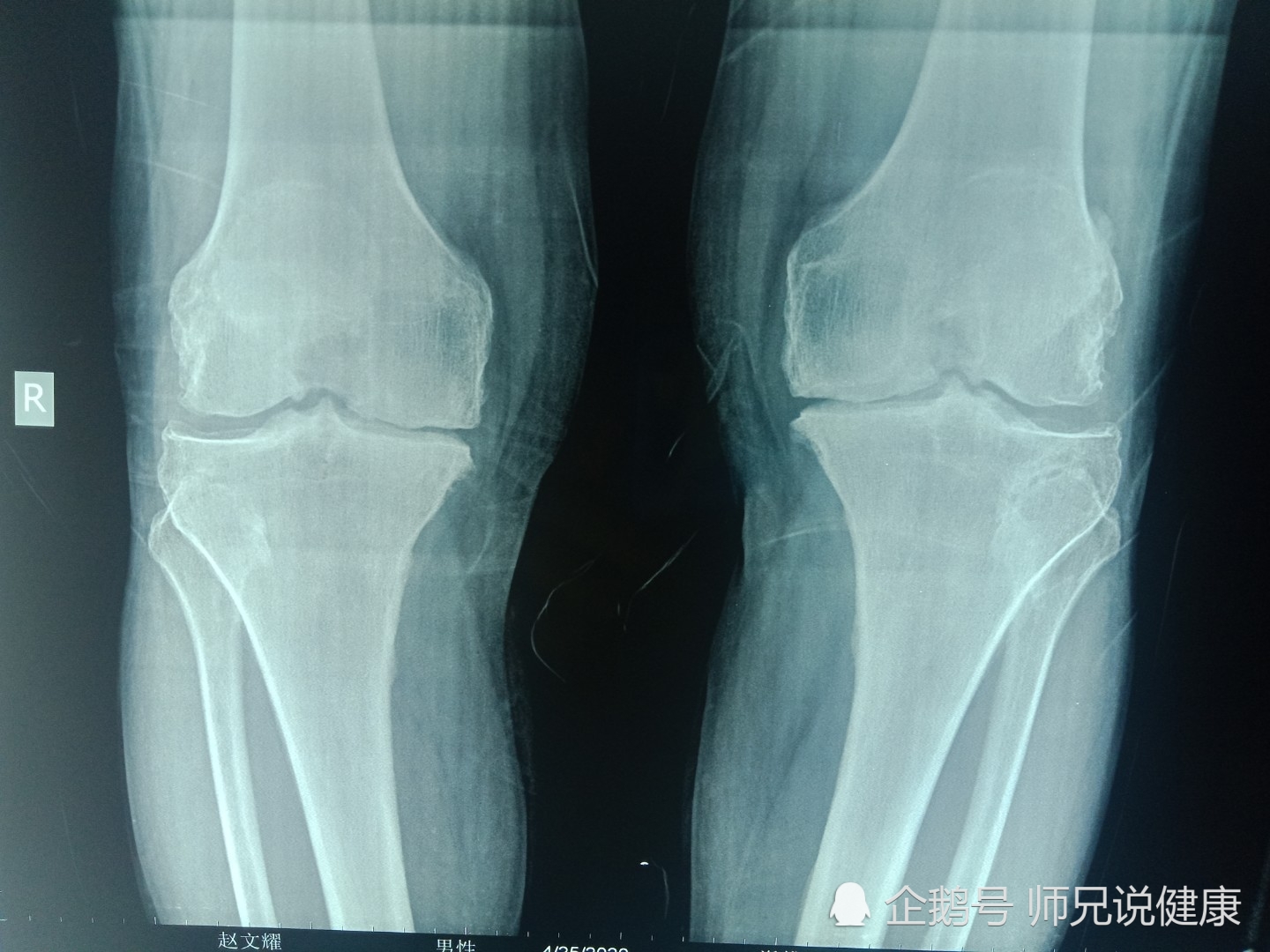 膝关节疼痛已忽略的问题——髌下脂肪垫炎