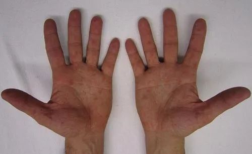 新冠肺炎,传染病,症状,手足口病,高发,流行性腮腺炎