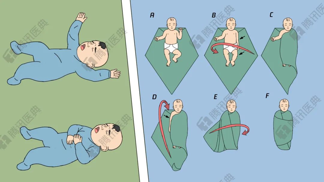 宝宝受到刺激后,会出现双臂伸直,手指张开,背部伸展或者弯曲,头朝后仰