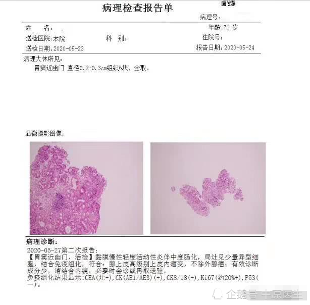 胃癌,大便出血,河南省人民医院,消化道出血,梁宝松