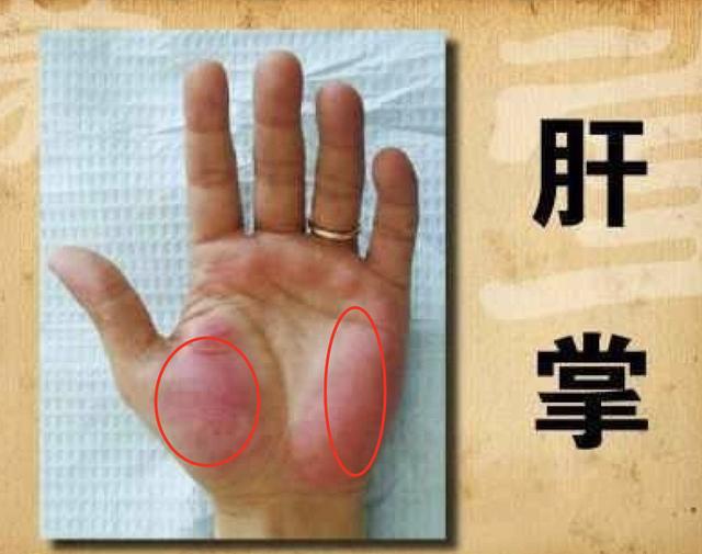 停止按压后又会迅速恢复,这样的一种手掌的症状,往往被称作"肝掌"