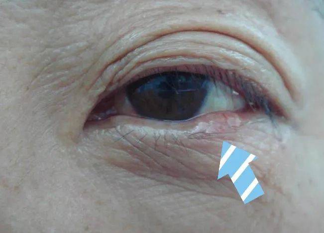 (睑板腺癌) 王富华表示眼睑基底细胞癌早期表现与老年斑极为相似