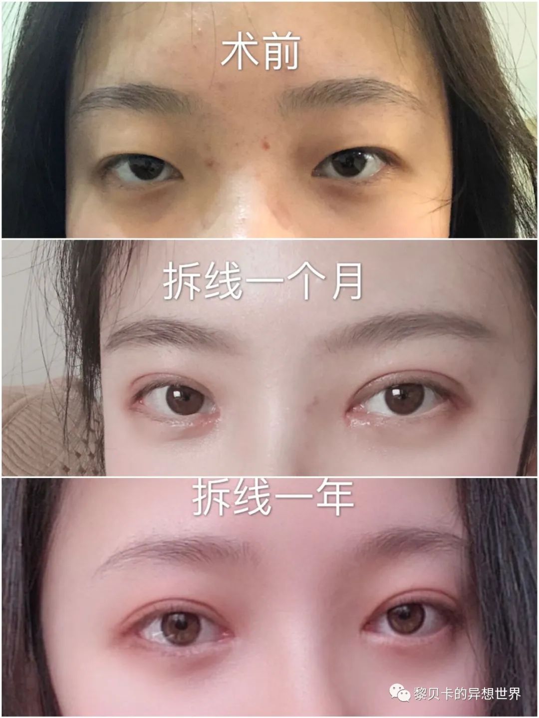 双眼皮,瘦脸