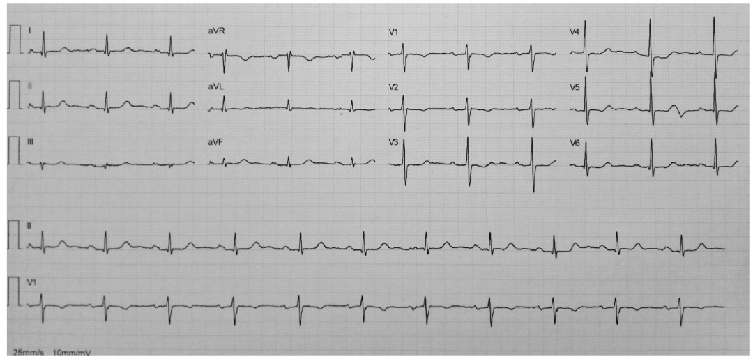 心电图,胸痛,急性心包炎