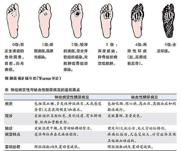 糖尿病人出现这几个征兆,糖尿病足可能要来临了,需要多多注意