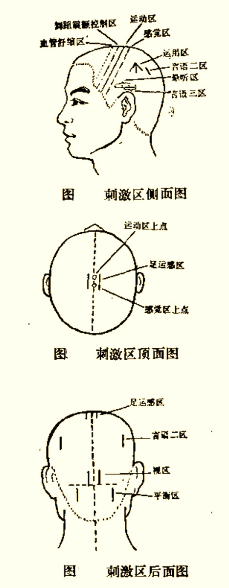 头针,针灸,头部穴位,运动感觉