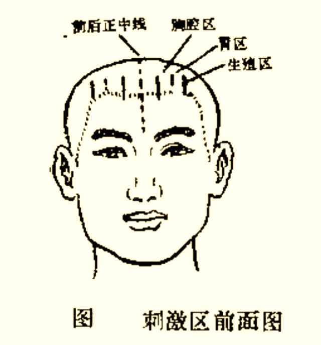 头针,针灸,头部穴位,运动感觉