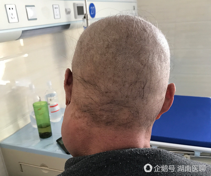 长沙五旬厨师常试味烫食患舌癌 三类人易患舌癌