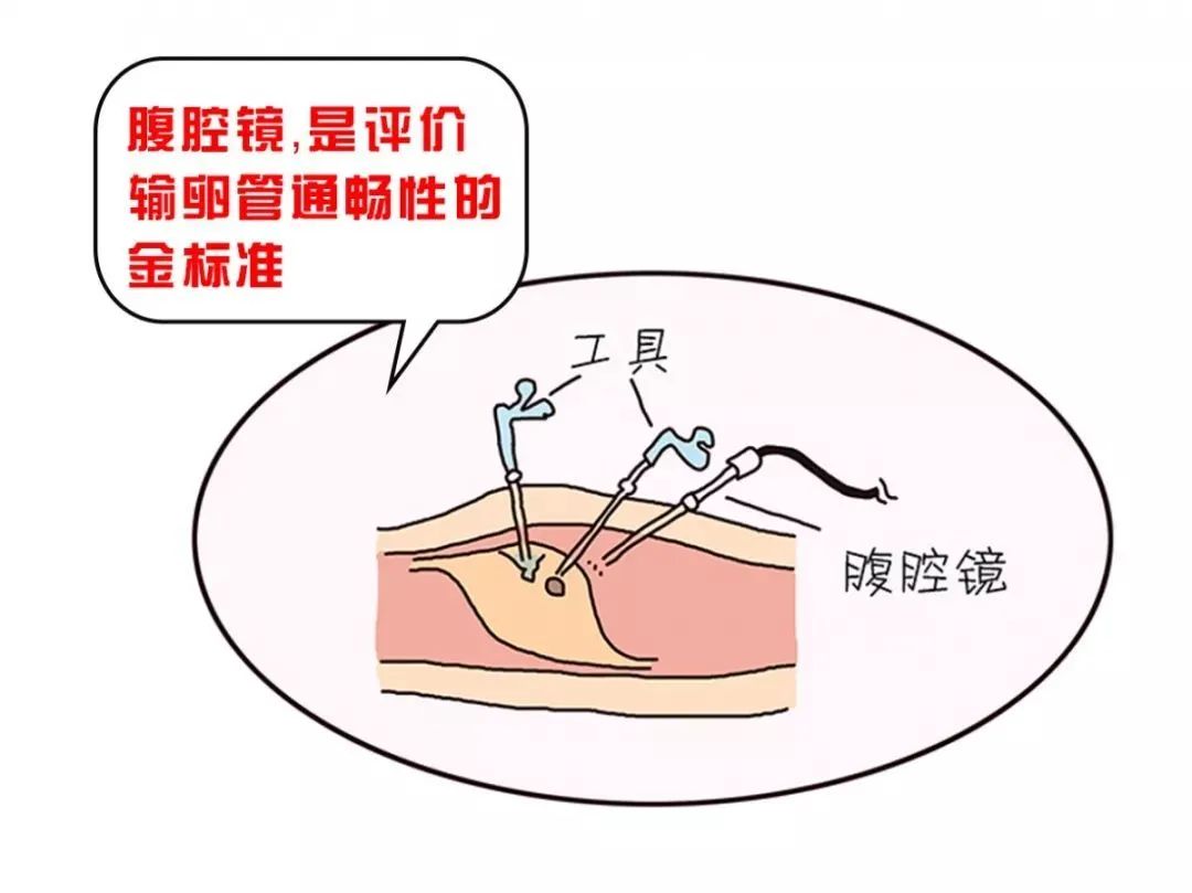 女人结扎后还可以再生育吗?