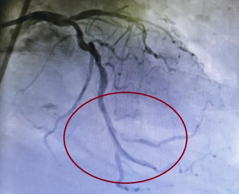 心脏不停跳,"一站式"冠脉杂交手术让冠心病患者不再"换乘"