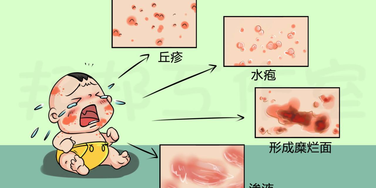 婴儿湿疹,痱子,宝宝,红斑