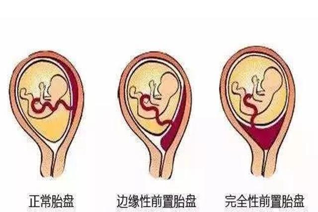 亲子,孕期,子宫,胎盘,位置