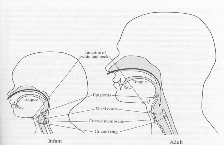 婴儿会厌长而硬,呈"u"型,且向前移位, 声门显露困难.