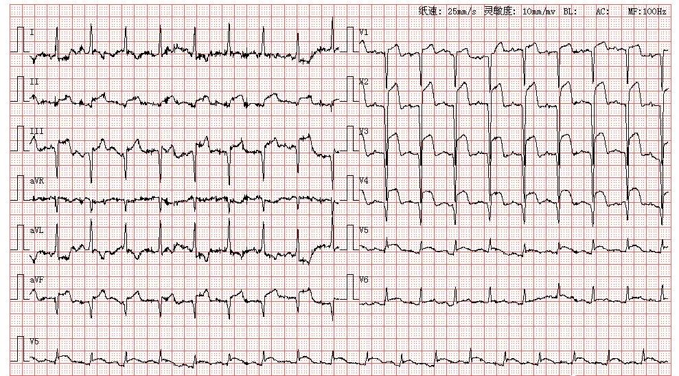 心肌梗死,窦性心动过速,心电图,胸痛