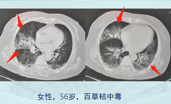 2位农药中毒的女病人,其中一位,喝了百草枯