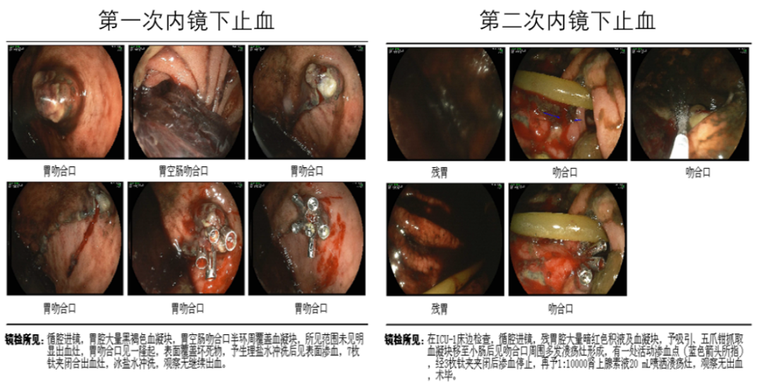 止血,第二附属医院,内镜,海南医学院,肿瘤,生长抑素