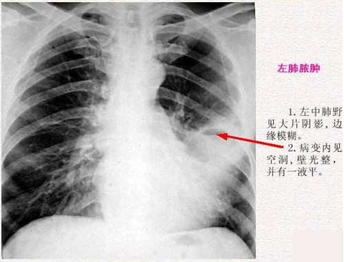 「一般是 急性起病,临床上有严重者整个肺到处都是肺脓肿,继而出现