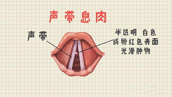 武汉耳鼻咽喉科专家提醒大家:声带息肉的危害很可怕,且发病率极高!