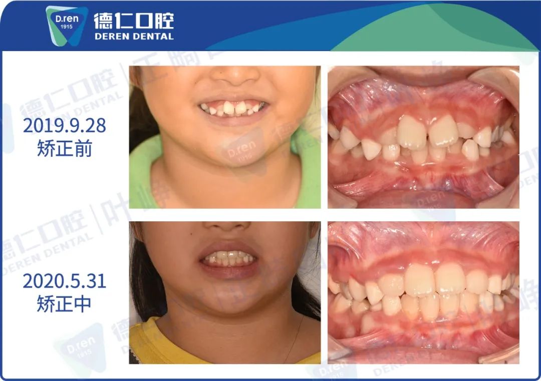 引导颌骨正向发育 德仁口腔儿牙早期干预系统,就是服务于5-12岁牙颌
