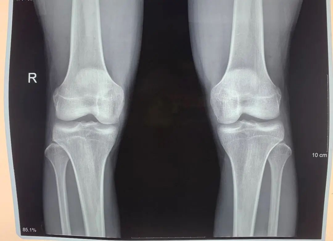 膝关节滑膜炎,髌骨软化症一例治验报告