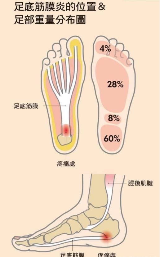 最典型的临床症状是足跟部位出现疼痛和不适,压痛点位置多在足底近