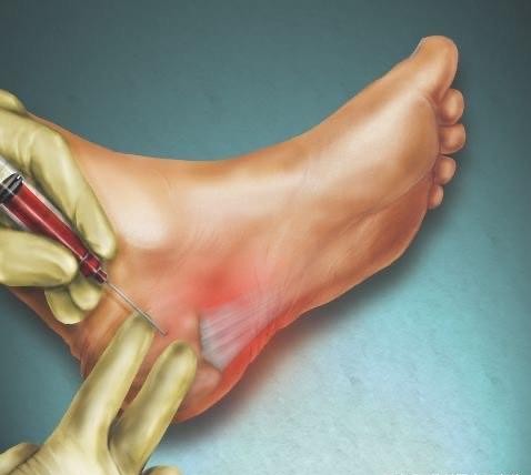 脚后跟疼痛是骨刺造成的吗?