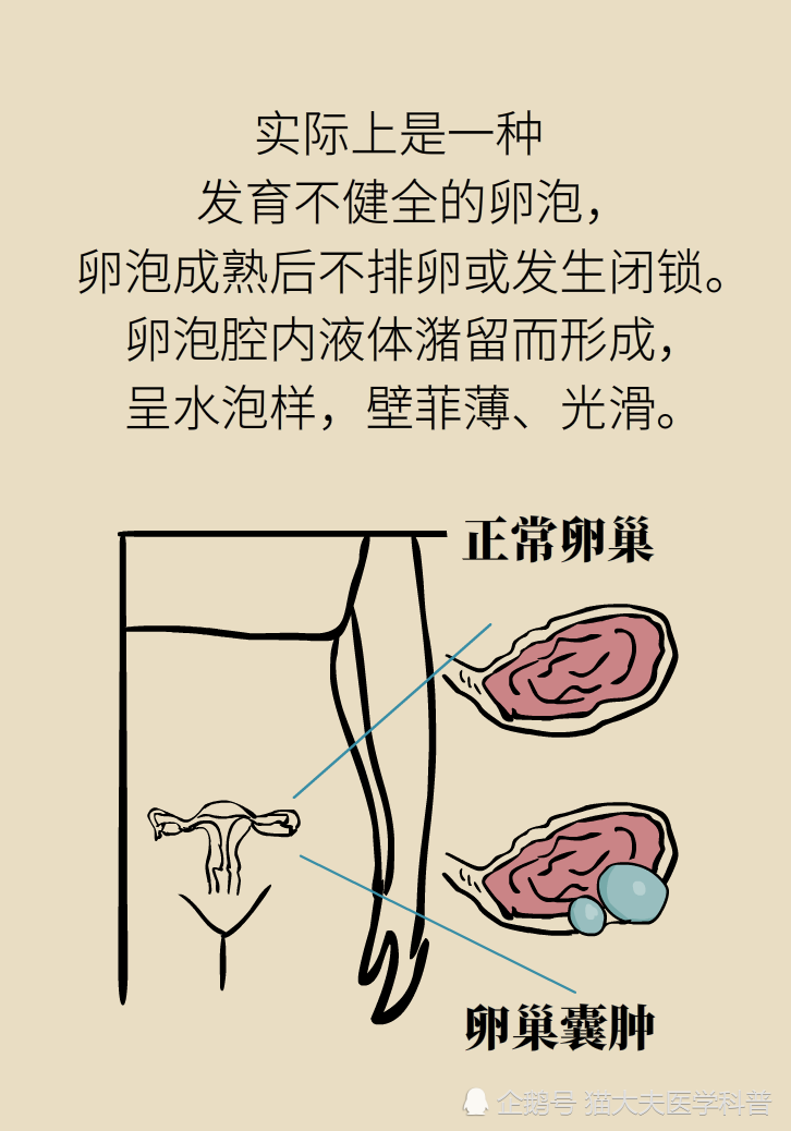 卵巢囊肿是肿瘤吗?需不需要治疗?