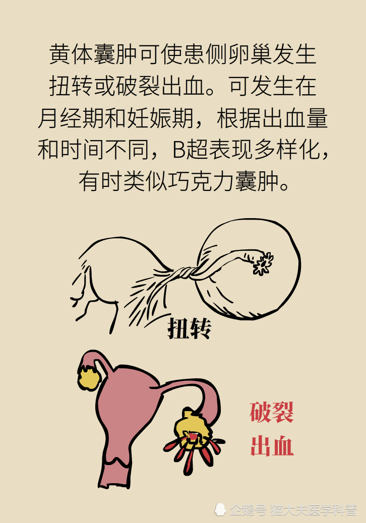 卵巢囊肿是肿瘤吗?需不需要治疗?